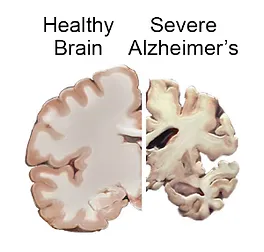 A picture of two different sections of the brain.